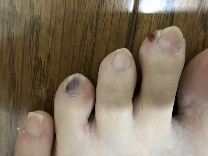 ドラクエウォークダイエット実践51日目に足の指の爪の下が内出血した
